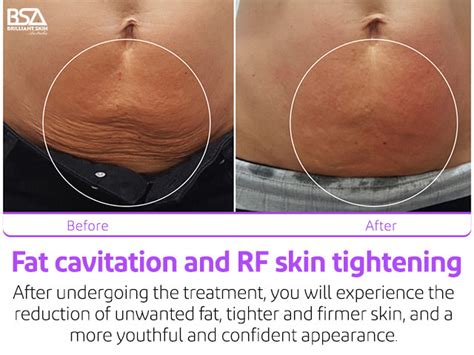 fat cavitation northbridge
